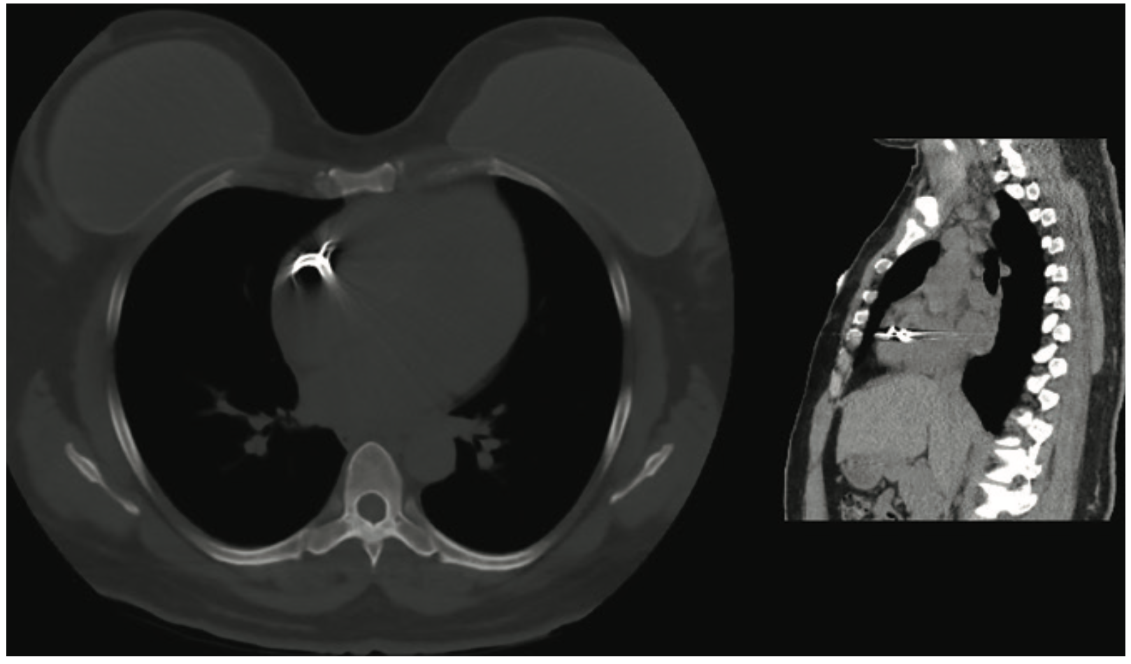 Coil Embolization to the Right Side of the Heart After Elective